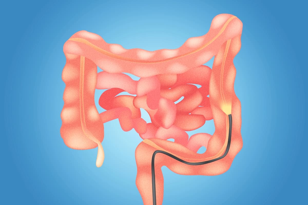 Una sola sigmoidoscopia reduce el riesgo de cáncer colorrectal por más de 20 años