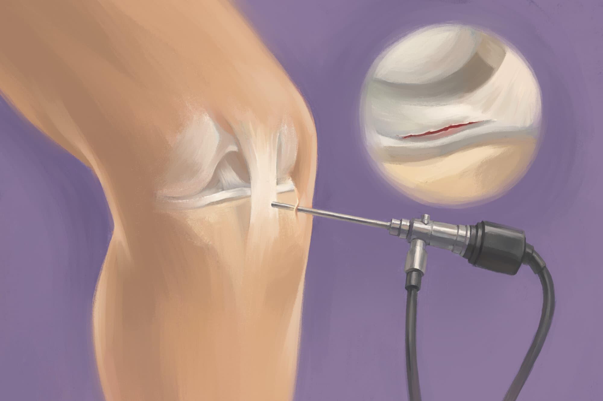 Cirugía artroscópica de rodilla. (Ilustración de Ran/The Epoch Times).