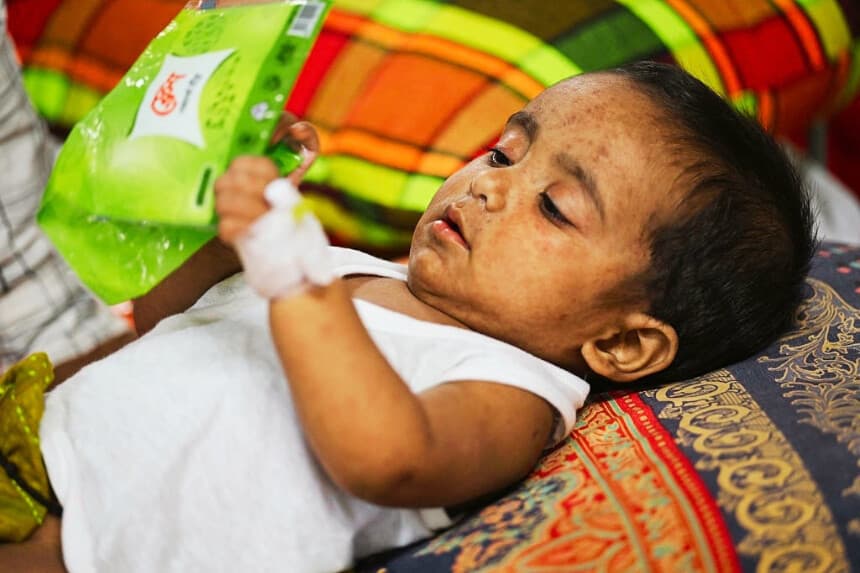 Bangladés enfrenta el mayor brote activo de sarampión con más de 200,000 casos sospechosos
